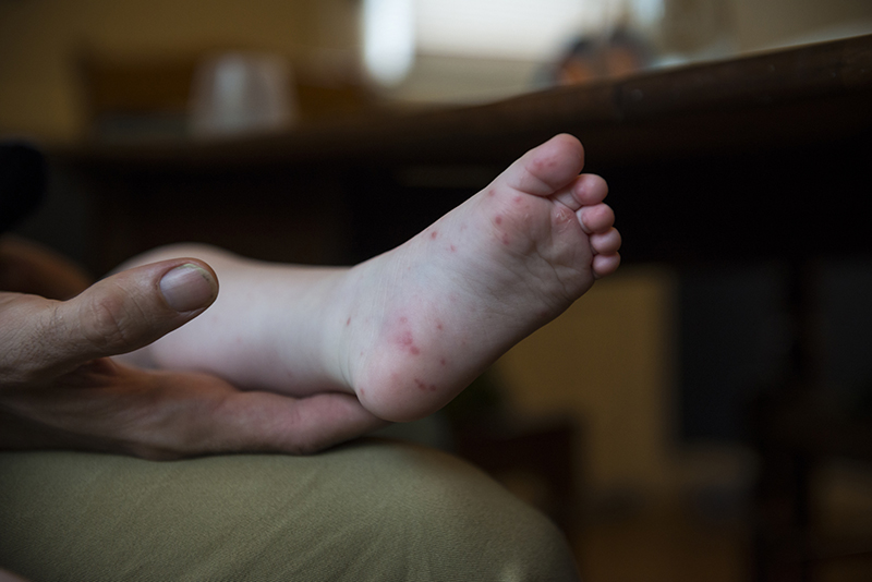 586358798_Hand_Foot_and_Mouth_Disease